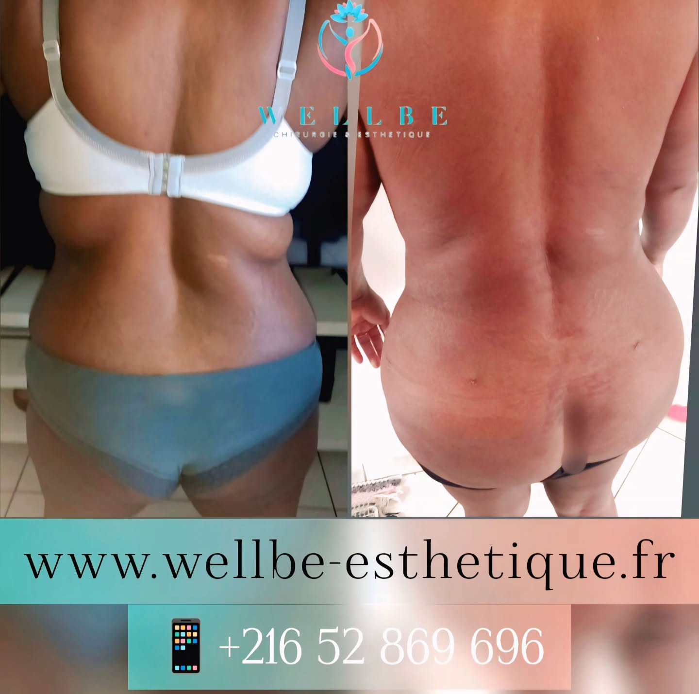 Résultat IMMÉDIAT 🔥 Réduction mammaire avec Lifting + Liposuccion plusieurs zones avec Abdominoplastie + BBL 🔥
————————————————————————
☎️Contactez-nous pour un Devis gratuit et personnalisé
WhatsApp 📲 + 216 52 869 696
📧 devis@wellbe-esthetique.fr
https://wellbe-esthetique.fr/
-————————————————————————
#chirurgieesthetique #plasticsurgery #chirurgieplastique #medecineesthetique #chirurgienesthetique #augmentationmammaire #rhinoplastie #liposuccion #tummytuck #bbl #facelift #botox #fillers #acidehyaluronique #avantapres #transformation #beauty #aesthetic #cosmeticsurgery #beforeandafter #plasticsurgeon #chirurgienplasticien #chirurgieesthetiqueparis #tunisie #paris #france#wellbechirurgieesthetique#wellbetunisie#wellbe