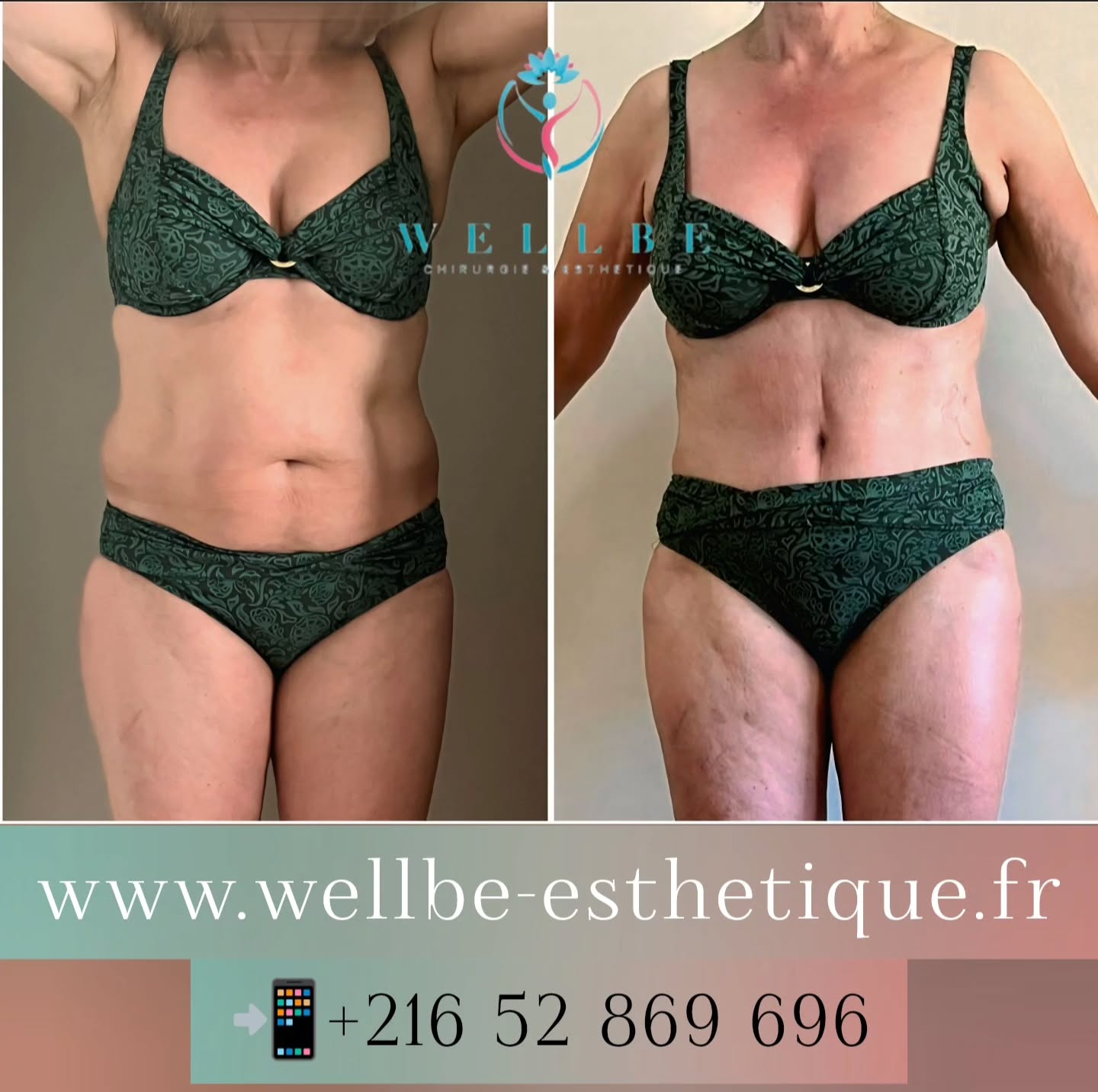 Résultat IMMÉDIAT 🔥Liposuccion plusieurs zones avec Abdominoplastie 🔥
————————————————————————
☎️Contactez-nous pour un Devis gratuit et personnalisé
WhatsApp 📲 + 216 52 869 696
📧 devis@wellbe-esthetique.fr
https://wellbe-esthetique.fr/
-————————————————————————
#chirurgieesthetique #plasticsurgery #chirurgieplastique #medecineesthetique #chirurgienesthetique #augmentationmammaire #rhinoplastie #liposuccion #tummytuck #bbl #facelift #botox #fillers #acidehyaluronique #avantapres #transformation #beauty #aesthetic #cosmeticsurgery #beforeandafter #plasticsurgeon #chirurgienplasticien #chirurgieesthetiqueparis #tunisie #paris #france#wellbechirurgieesthetique#wellbetunisie#wellbe