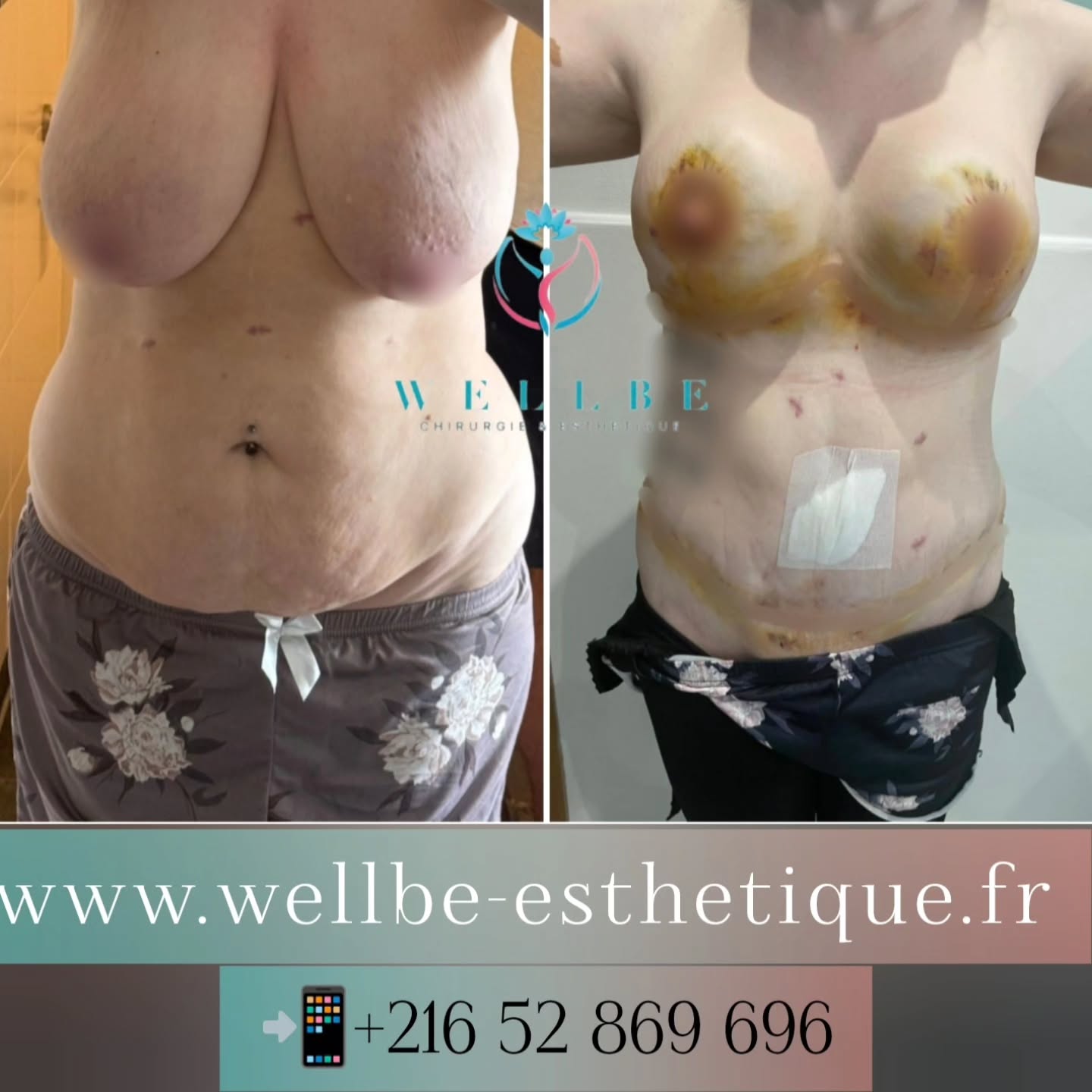 Résultat immédiat 🔥Abdominoplastie + Lifting mammaire 🔥
————————————————————————
☎️Contactez-nous pour un Devis gratuit et personnalisé
WhatsApp 📲 + 216 52 869 696
📧 devis@wellbe-esthetique.fr
https://wellbe-esthetique.fr/
-————————————————————————
#chirurgieesthetique #plasticsurgery #chirurgieplastique #medecineesthetique #chirurgienesthetique #augmentationmammaire #rhinoplastie #liposuccion #tummytuck #bbl #facelift #botox #fillers #acidehyaluronique #avantapres #transformation #beauty #aesthetic #cosmeticsurgery #beforeandafter #plasticsurgeon #chirurgienplasticien #chirurgieesthetiqueparis #tunisie #paris #france#wellbechirurgieesthetique#wellbetunisie#wellbe