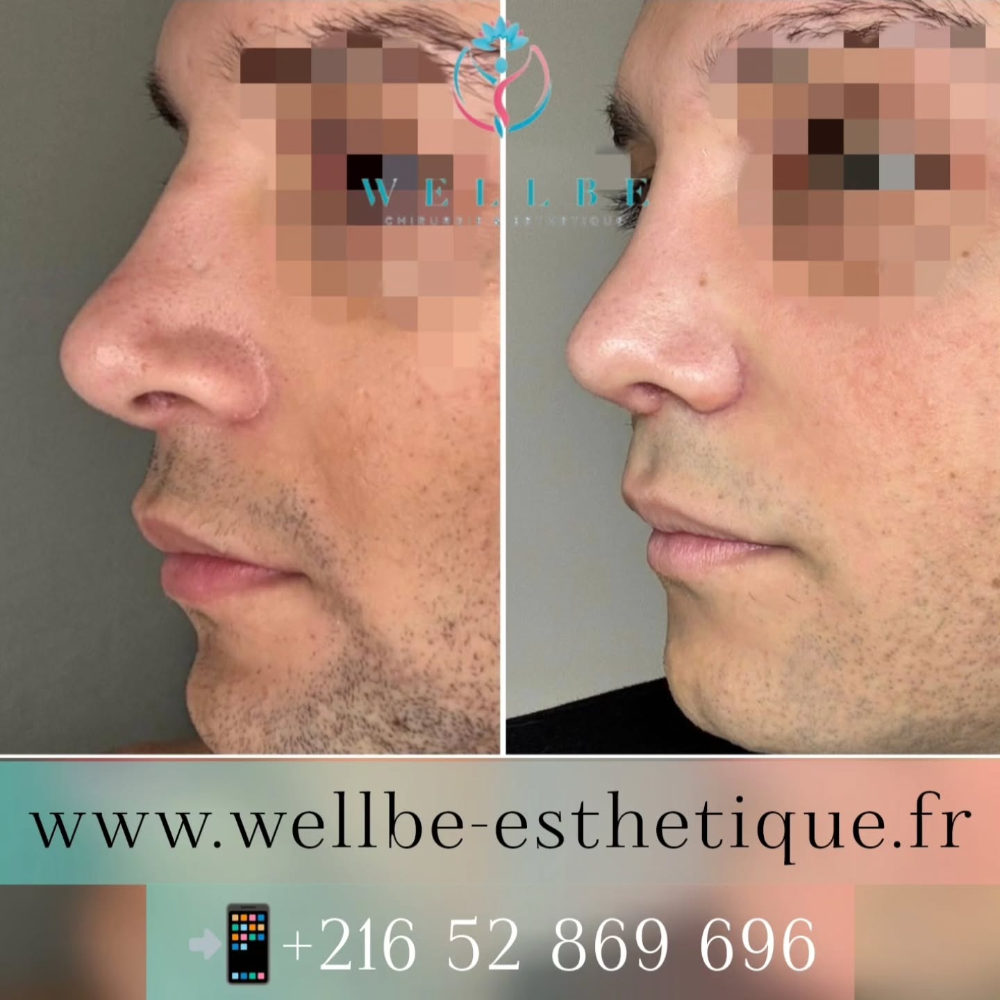 Résultat immédiat 🔥 Rhinoplastie Secondaire 🔥
————————————————————————
☎️Contactez-nous pour un Devis gratuit et personnalisé
WhatsApp 📲 + 216 52 869 696
📧 devis@wellbe-esthetique.fr
https://wellbe-esthetique.fr/
-————————————————————————
#chirurgieesthetique #plasticsurgery #chirurgieplastique #medecineesthetique #chirurgienesthetique #augmentationmammaire #rhinoplastie #liposuccion #tummytuck #bbl #facelift #botox #fillers #acidehyaluronique #avantapres #transformation #beauty #aesthetic #cosmeticsurgery #beforeandafter #plasticsurgeon #chirurgienplasticien #chirurgieesthetiqueparis #tunisie #paris #france#wellbechirurgieesthetique#wellbetunisie#wellbe