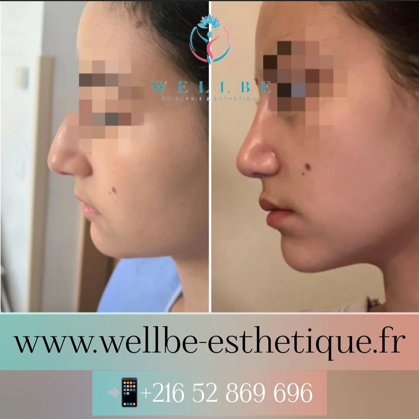 Résultat immédiat 🔥 Rhinoplastie 🔥
————————————————————————
☎️Contactez-nous pour un Devis gratuit et personnalisé
WhatsApp 📲 + 216 52 869 696
📧 devis@wellbe-esthetique.fr
https://wellbe-esthetique.fr/
-————————————————————————
#chirurgieesthetique #plasticsurgery #chirurgieplastique #medecineesthetique #chirurgienesthetique #augmentationmammaire #rhinoplastie #liposuccion #tummytuck #bbl #facelift #botox #fillers #acidehyaluronique #avantapres #transformation #beauty #aesthetic #cosmeticsurgery #beforeandafter #plasticsurgeon #chirurgienplasticien #chirurgieesthetiqueparis #tunisie #paris #france#wellbechirurgieesthetique#wellbetunisie#wellbe