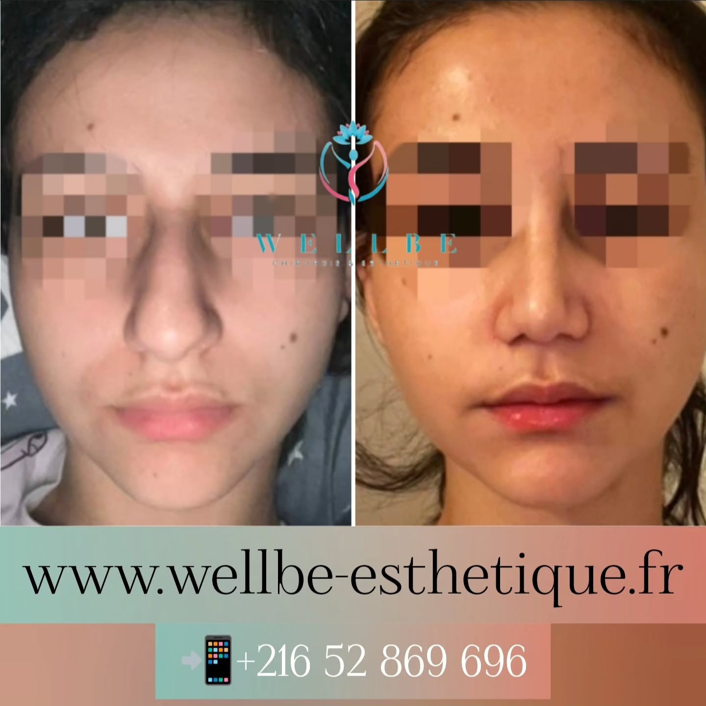 Résultat immédiat 🔥 Rhinoplastie 🔥
————————————————————————
☎️Contactez-nous pour un Devis gratuit et personnalisé
WhatsApp 📲 + 216 52 869 696
📧 devis@wellbe-esthetique.fr
https://wellbe-esthetique.fr/
-————————————————————————
#chirurgieesthetique #plasticsurgery #chirurgieplastique #medecineesthetique #chirurgienesthetique #augmentationmammaire #rhinoplastie #liposuccion #tummytuck #bbl #facelift #botox #fillers #acidehyaluronique #avantapres #transformation #beauty #aesthetic #cosmeticsurgery #beforeandafter #plasticsurgeon #chirurgienplasticien #chirurgieesthetiqueparis #tunisie #paris #france#wellbechirurgieesthetique#wellbetunisie#wellbe