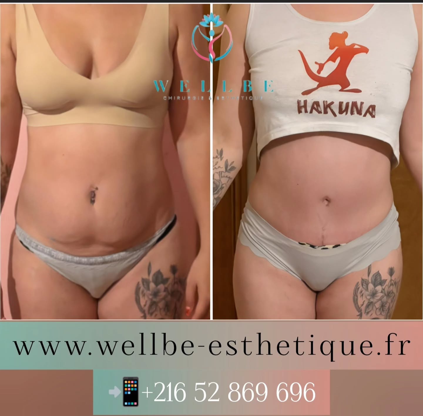 Résultat immédiat 🔥 Abdominoplastie avec Liposuccion 🔥
————————————————————————
☎️Contactez-nous pour un Devis gratuit et personnalisé
WhatsApp 📲 + 216 52 869 696
📧 devis@wellbe-esthetique.fr
https://wellbe-esthetique.fr/
-————————————————————————
#chirurgieesthetique #plasticsurgery #chirurgieplastique #medecineesthetique #chirurgienesthetique
