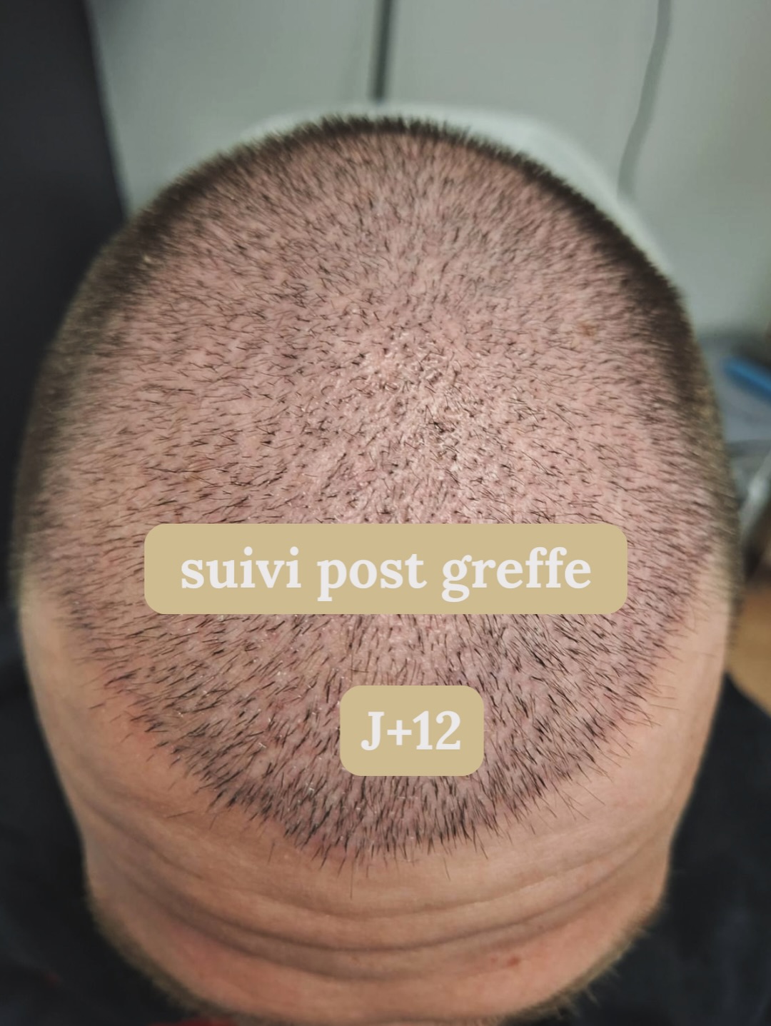 Greffe de cheveux : évolution à J+12, suite du suivi
Aujourd’hui, je vous partage l’évolution à J+12 du patient dont vous avez déjà vu le suivi à J+4 et J+9, après sa greffe de cheveux réalisée à Istanbul avec une technique FUE + DHI.
À ce stade, le cuir chevelu a bien évolué :
la phase de cicatrisation est avancée, les croûtes ont disparu et le cuir chevelu retrouve un aspect plus homogène.
👉 C’est une étape rassurante, mais aussi une phase clé.
Beaucoup pensent que tout est terminé… alors que le processus de repousse ne fait que commencer.
Dans les semaines à venir, les cheveux greffés vont entrer dans une phase normale de chute avant de laisser place à la repousse progressive.
C’est précisément pour cela que le suivi post greffe de cheveux est essentiel.
En tant qu’expert capillaire, j’accompagne mes patients dans la durée pour :
🔍 suivre l’évolution du cuir chevelu
🤝 répondre aux questions
🧴 adapter les soins
📈 optimiser les résultats
Que la greffe soit réalisée en France ou à l’étranger, cet accompagnement permet de rester serein à chaque étape.
📱 Le suivi est possible à distance partout en France, en complément des rendez-vous au centre.
📍 Centre Expertise Capillaire Sébastien Gillmann – Strasbourg
👣 10 min à pied de la gare de Strasbourg
🚋 1 min du tram Homme de Fer
📅 Diagnostic capillaire gratuit sur rendez-vous
👉 Réservez sur planity.fr
#GreffeDeCheveux #SuiviPostGreffe #FUE #DHI #expertcapillairestrasbourg
